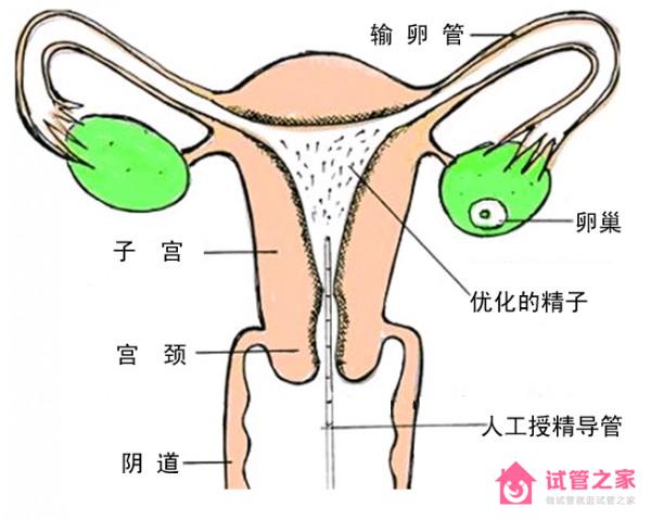 人工授精是把精子注入到哪個(gè)部位