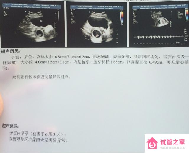 染色體異常怎么辦？看看我的試管嬰兒經(jīng)歷