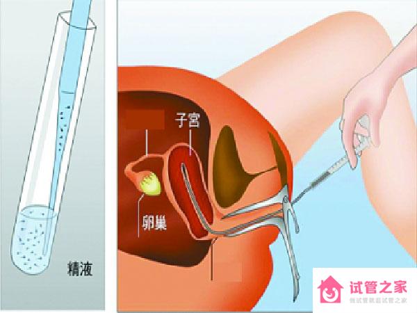 做供精人工授精的條件是什么，適不適合一看便知