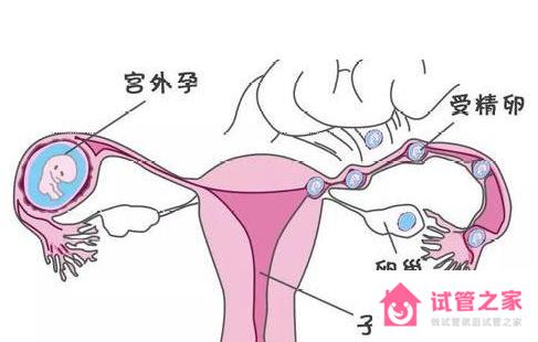 多次宮外孕泰國試管嬰兒成功率高嗎？