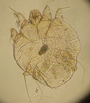 難言的外生殖器皮膚病之「疥瘡」