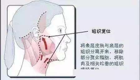 小切口拉皮除皺 詳細(xì)解讀！