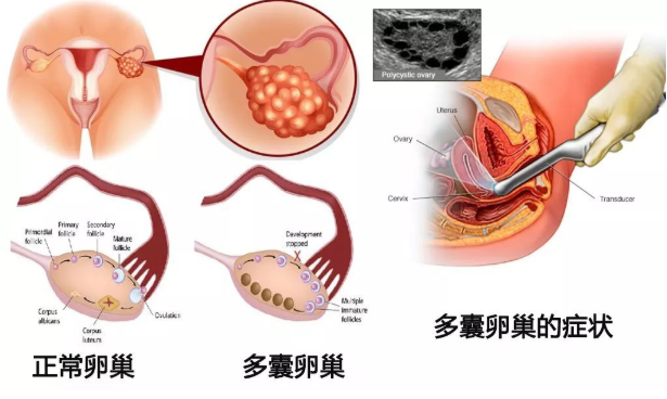 多囊試友的脫發(fā)問題，背后真正的原因