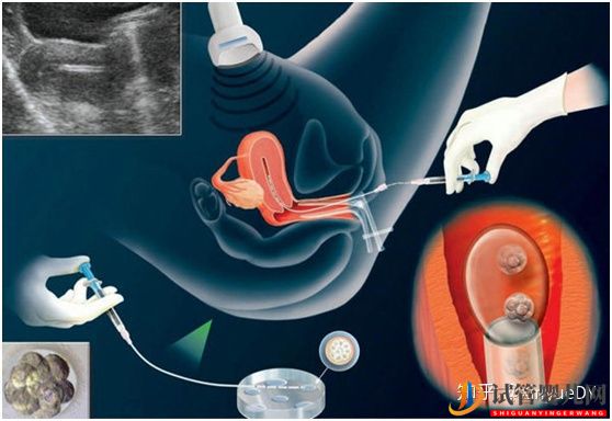 凍胚移植的流程概述_子宮內(nèi)膜及身體準(zhǔn)備非常重要