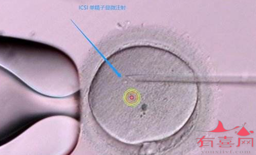 單精子*漿注射的適應(yīng)癥有哪些