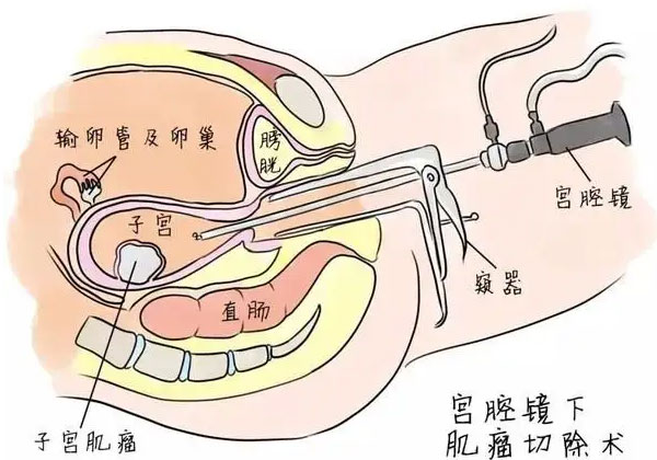 醫(yī)生不建議做宮腔鏡是謠言，出現(xiàn)8種情況還真有必要