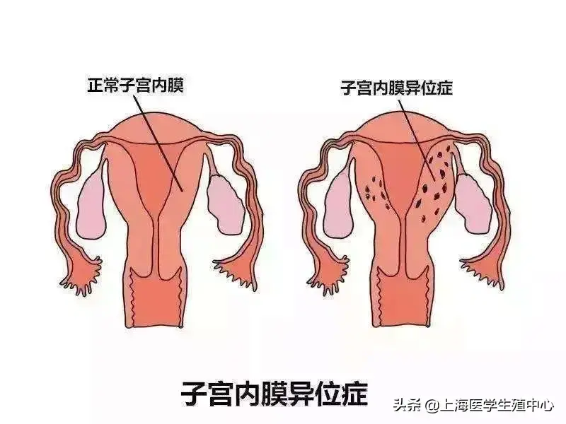 女性試友得了子宮內(nèi)膜異位癥，還能懷孕嗎？