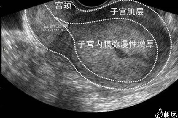 子宮內(nèi)膜13b真不適合試管囊胚移植，再想要懷孕也得慎重