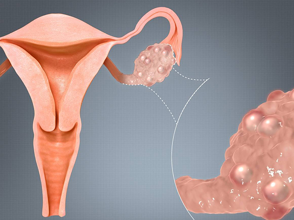 多囊也分胖和瘦，瘦多囊是否難治、難懷孕一文說清