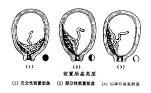 試管嬰兒的產(chǎn)科風險是什么？