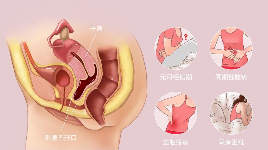 先天性幼稚子宮能懷孕嗎？只要*巢正常也能圓父母夢