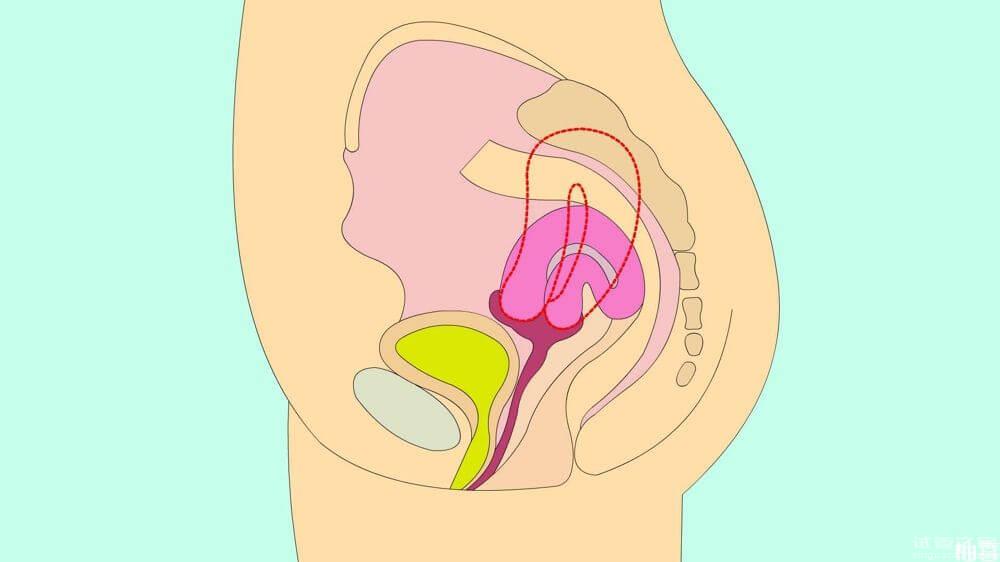 子宮后位4個(gè)癥狀提醒你！及時(shí)檢查診斷是關(guān)鍵