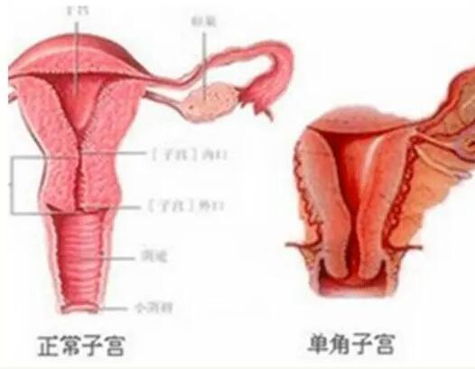 殘角子宮切除掉還能生孩子嗎？做試管要多少錢？