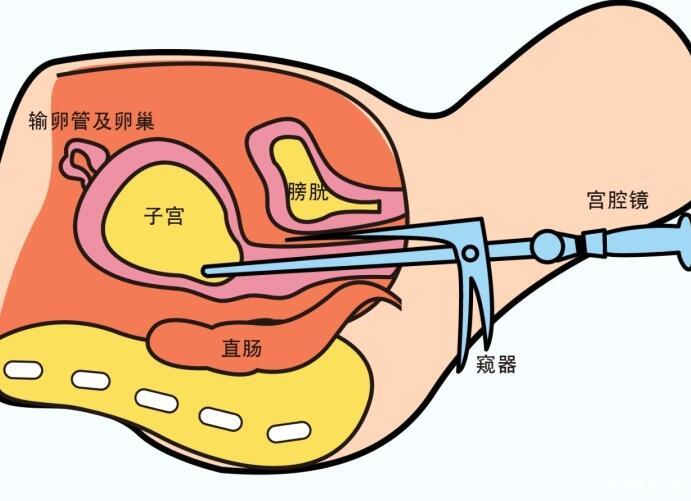 輸卵管問題做幾代試管能懷孕多少錢？