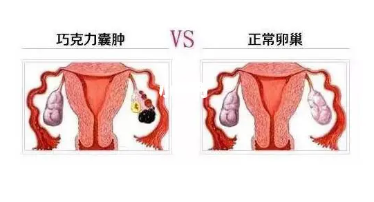 卵巢囊腫在哪個(gè)部位：卵巢囊腫在哪個(gè)部位??