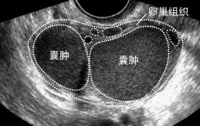 巧克力囊腫是什么??？卵巢異位囊腫如何治療？治療巧克力囊腫必須手術嗎？ ...