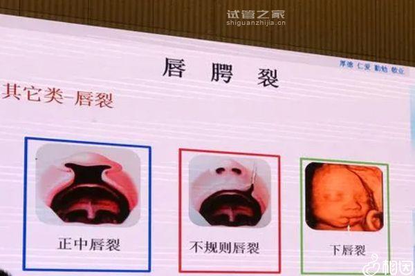 一文詳解2q13微缺失孩子能不能要，盲目留下危害真不小