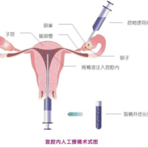 人工授精是怎么樣的助孕過程？跟試管嬰兒又有什么區(qū)別呢？ 