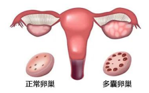 多囊*巢綜合征的正確理解姿勢(shì)-歐洲和中國多囊*巢綜合征的診斷標(biāo)準(zhǔn) 