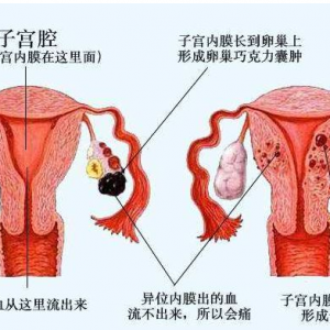 子宮內(nèi)膜異位患者可通過(guò)泰國(guó)試管嬰兒受孕嗎？