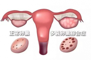 多囊患者做試管嬰兒前要“減肥”嗎？