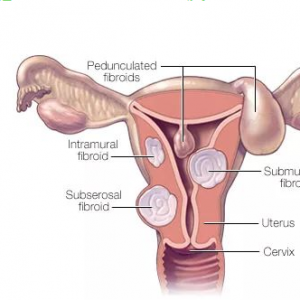 子宮肌瘤會影響試管嬰兒治療么？