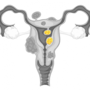 子宮肌瘤會影響試管嬰兒成功率嗎？該怎么處理？