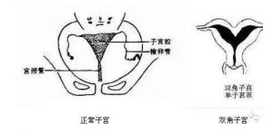 鞍型子宮可以做試管嬰兒嗎，要注意什么？